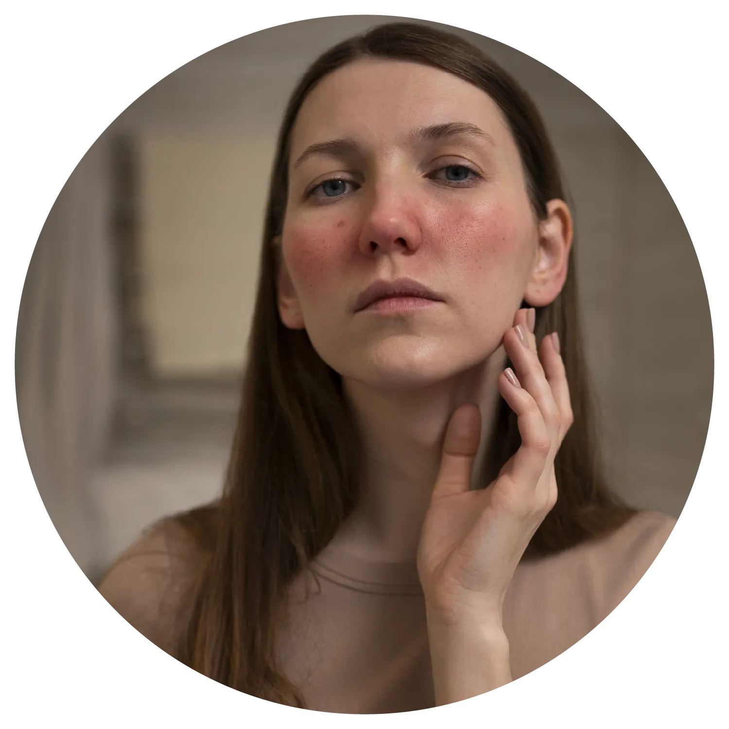 Rosacea treatment results at Toronto medical spa - The Chain Reaction of Symptoms